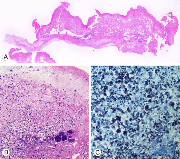 Infective Endocarditis Histology